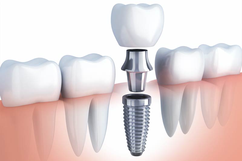 Single Tooth Implant